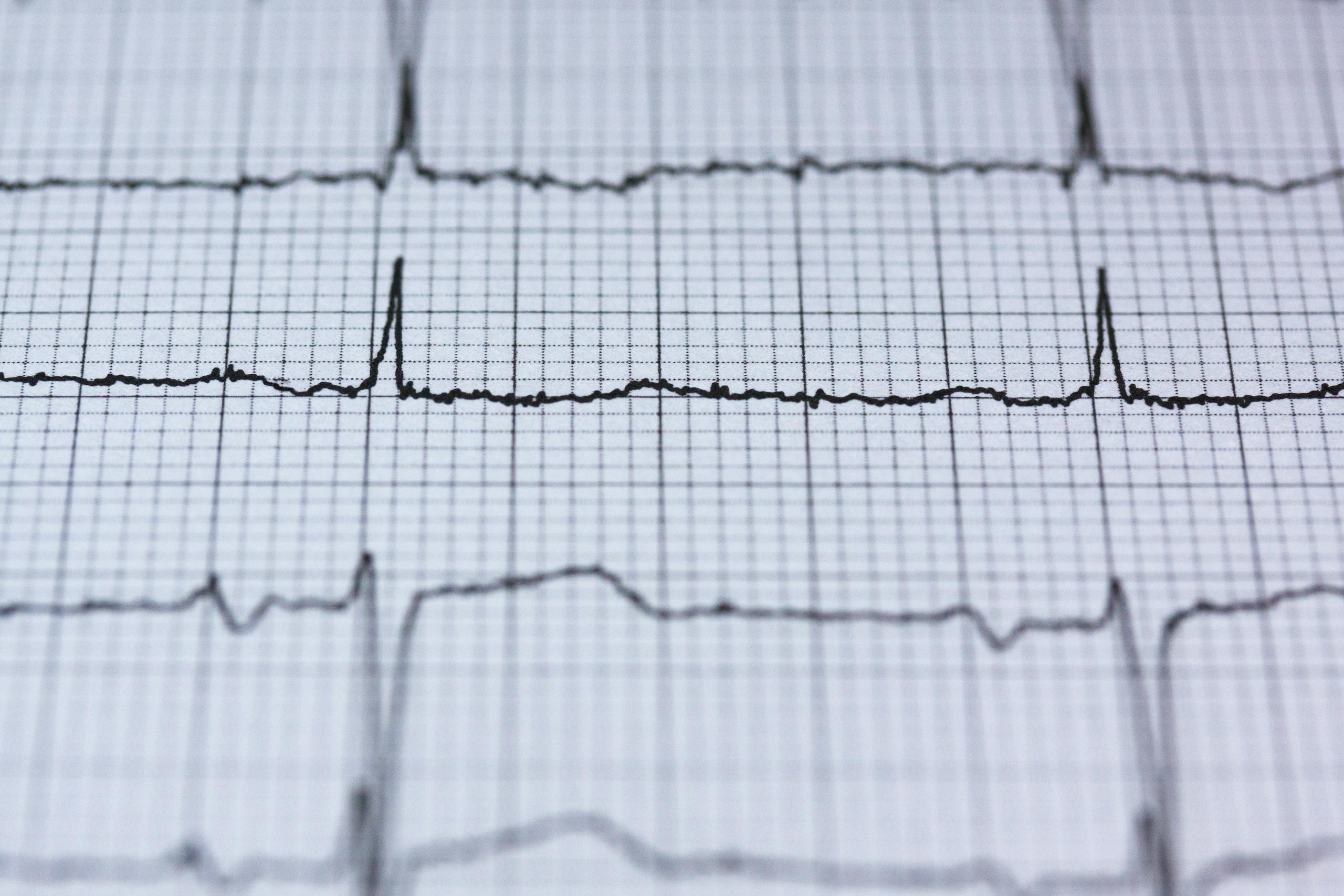 Close-up view of an ECG reading on graph paper, displaying heart rhythm and pulse data for medical analysis.